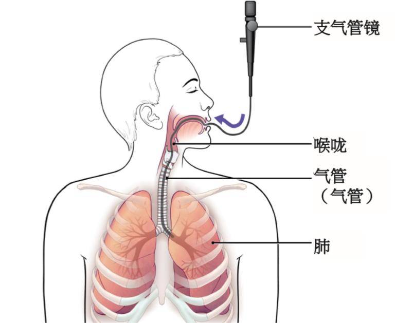 电子支气管镜厂家给您解读电子支气管镜在呼吸系统疾病中的应用