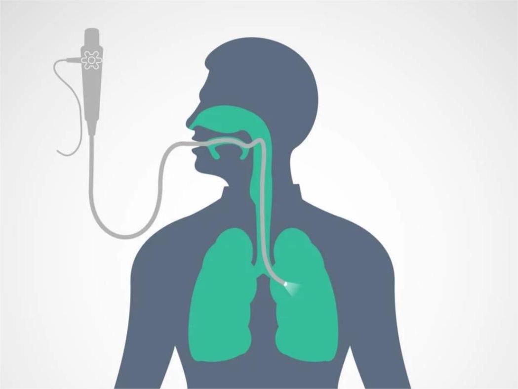 电子支气管镜在医疗实践中的应用